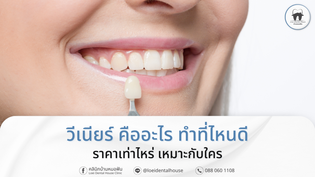วีเนียร์ คืออะไร ทำที่ไหนดี ราคาเท่าไหร่ เหมาะกับใคร