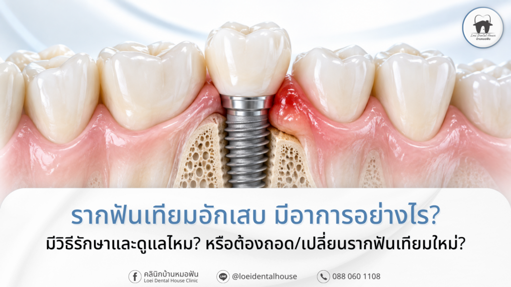 รากฟันเทียมอักเสบและเหงือกบวมแดงรอบรากฟันเทียม