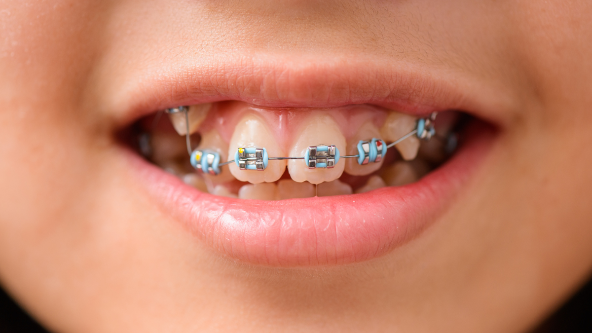 Advantages of Orthodontics for children Advantages of Orthodontics for children