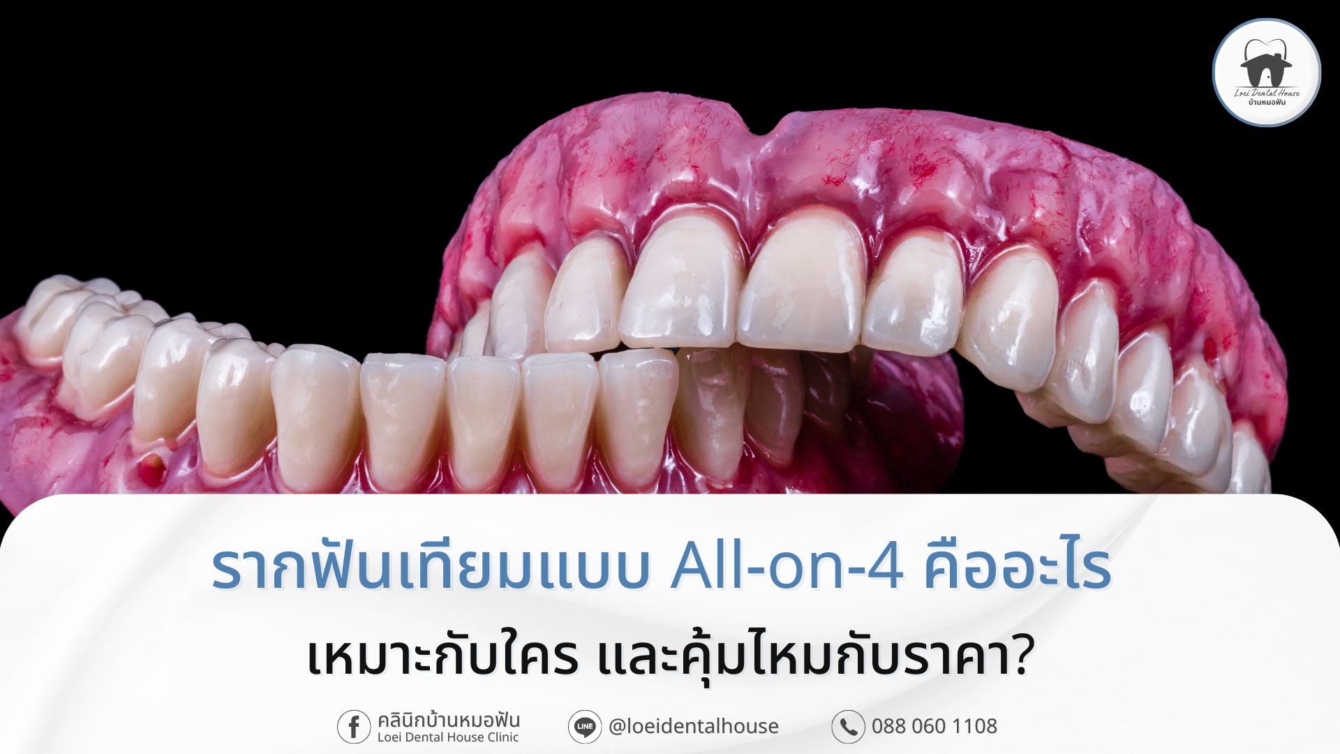รากฟันเทียมแบบ All-on-4 คืออะไร เหมาะกับใคร และคุ้มไหมกับราคา