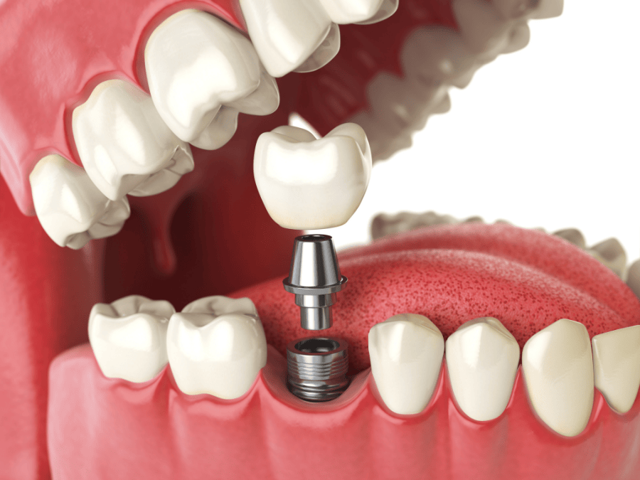 Single Implant Single Implant