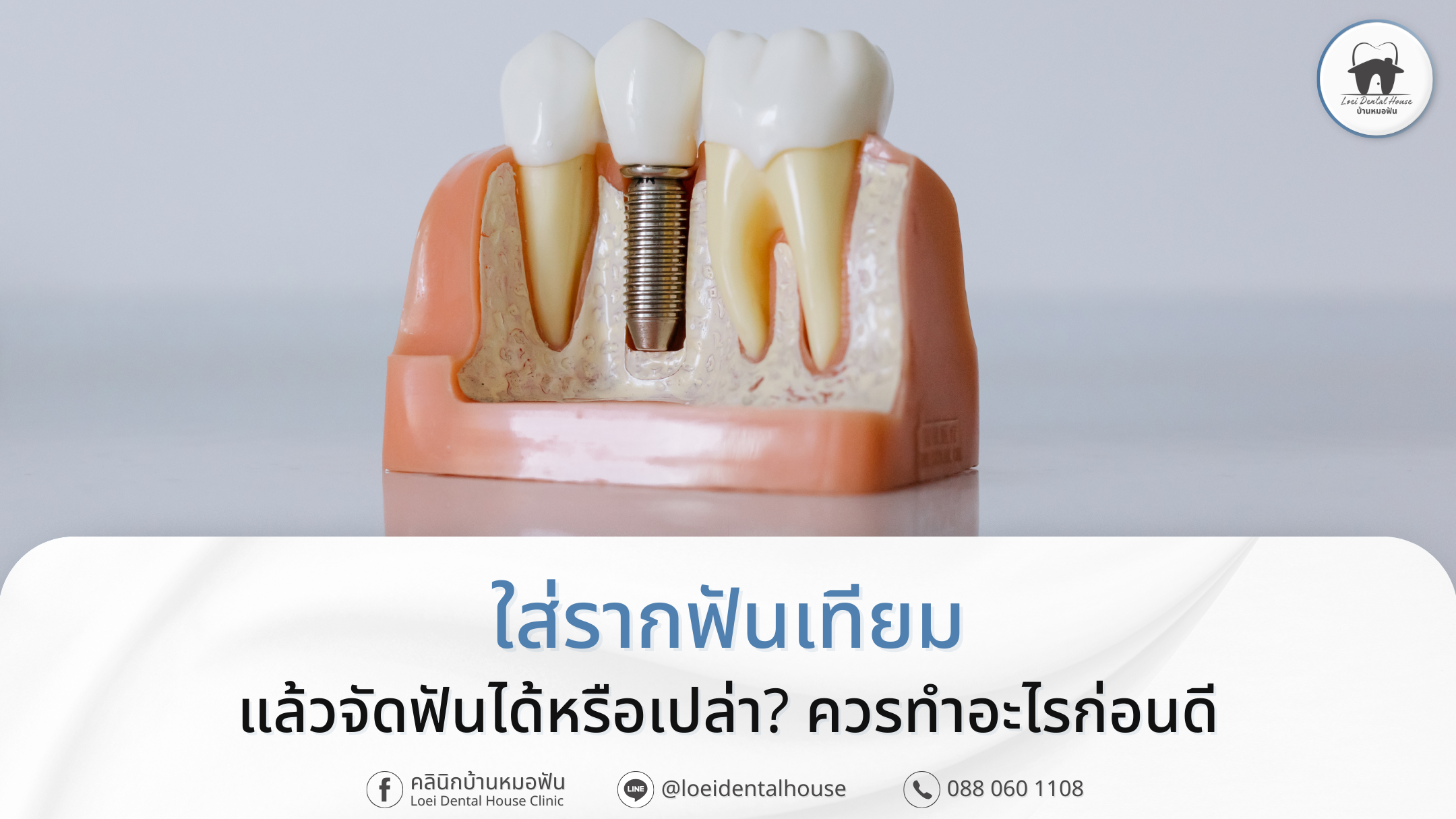 ใส่รากฟันเทียม