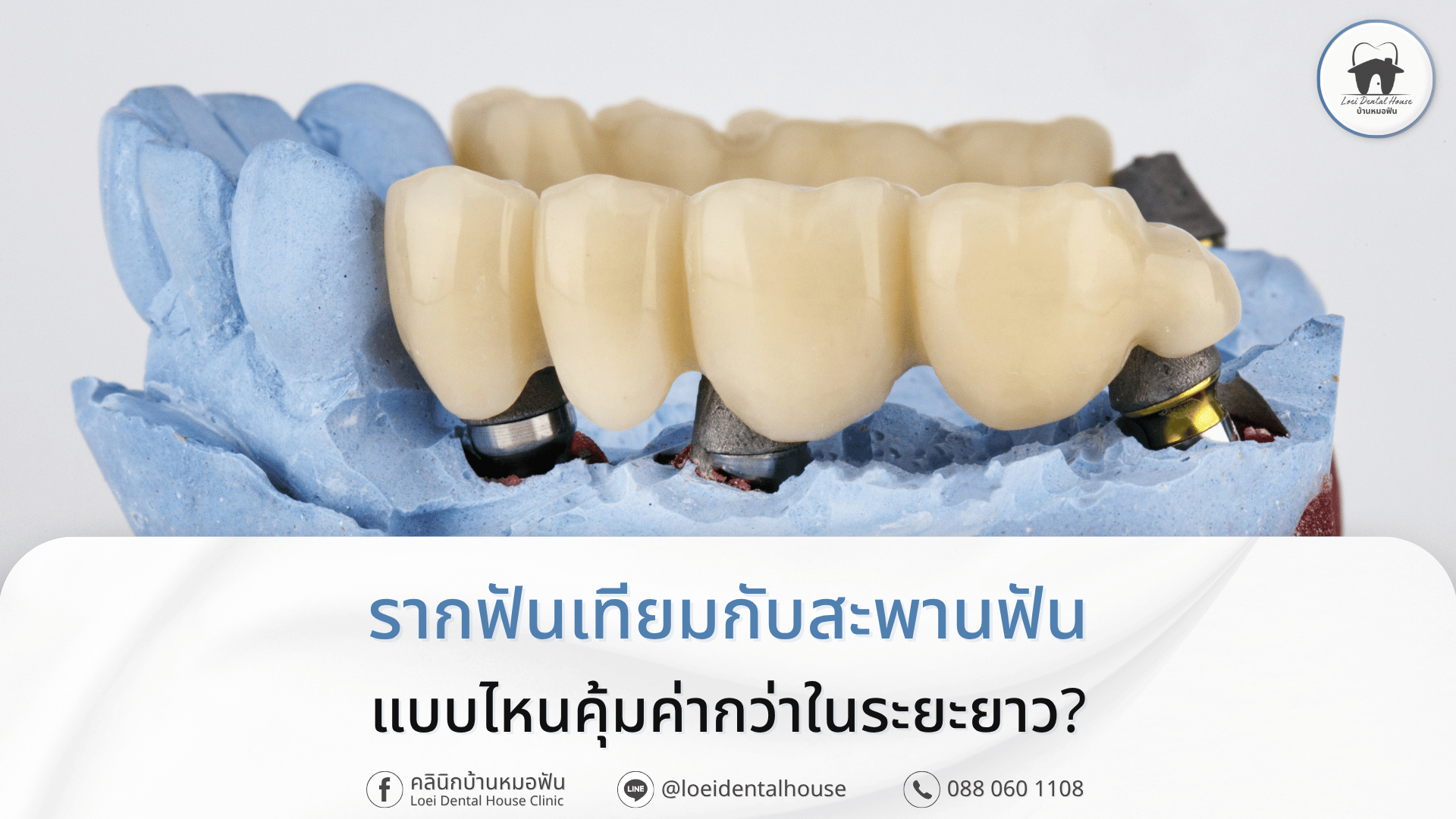 รากฟันเทียมกับสะพานฟัน แบบไหนคุ้มค่ากว่าในระยะยาว
