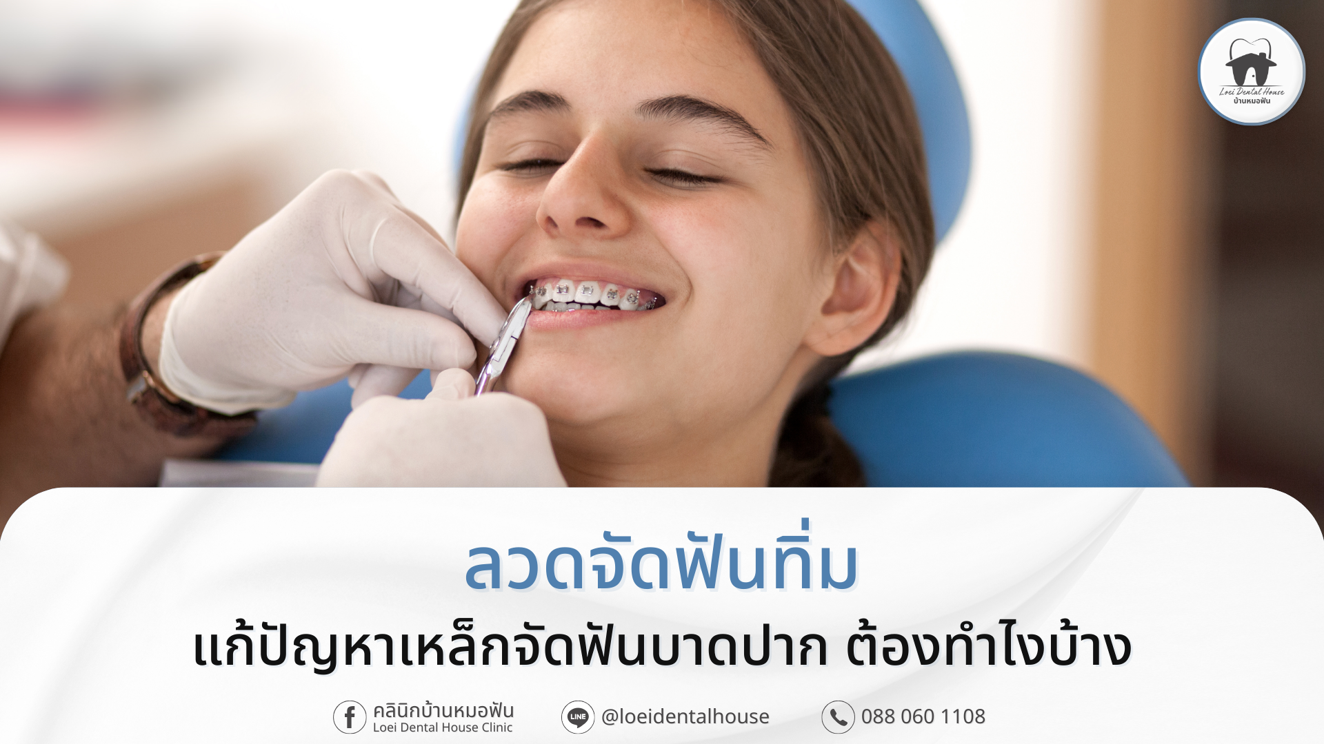 ลวดจัดฟันทิ่ม