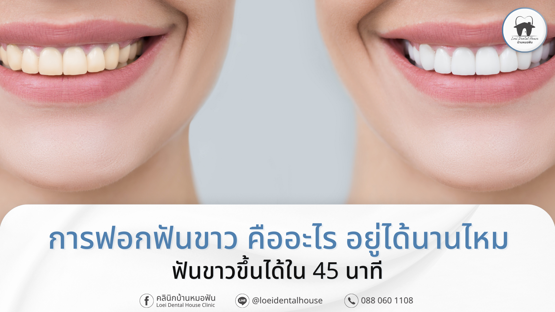 การฟอกฟันขาว คืออะไร อยู่ได้นานไหม