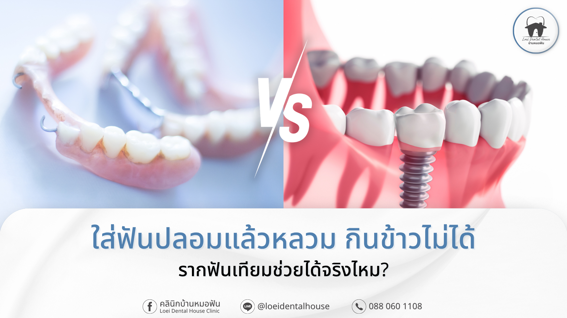 ฟันปลอมหลวม เปลี่ยนเป็นรากฟันเทียมดีไหม
