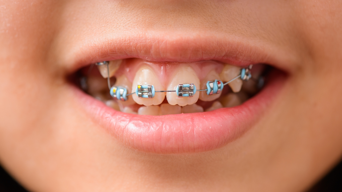 Advantages of Orthodontics for children