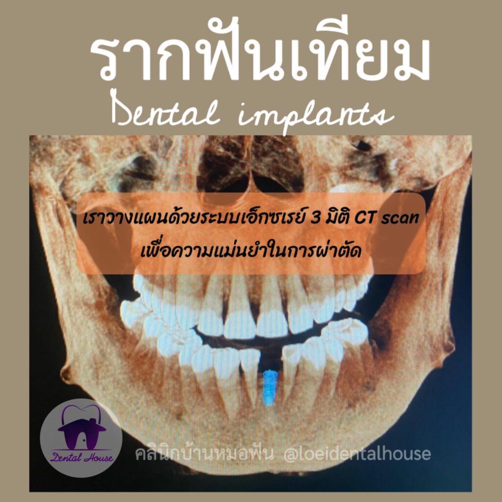 รากฟันเทียม ราคา