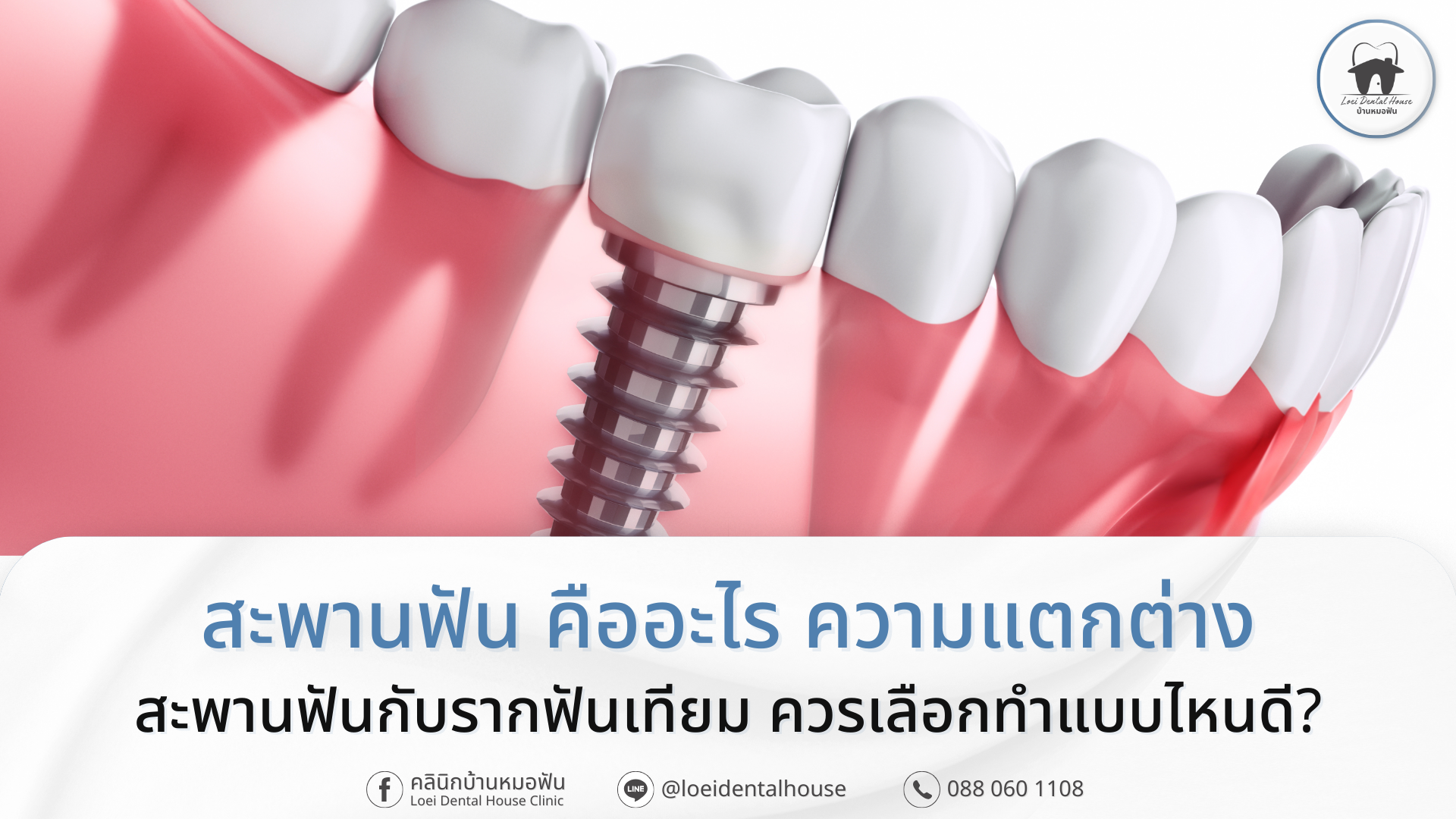 สะพานฟัน คืออะไร ความแตกต่าง