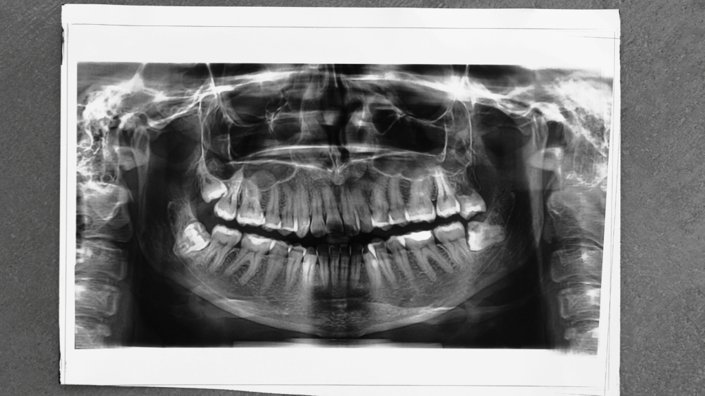 การปลูกกระดูก (Bone Grafting)