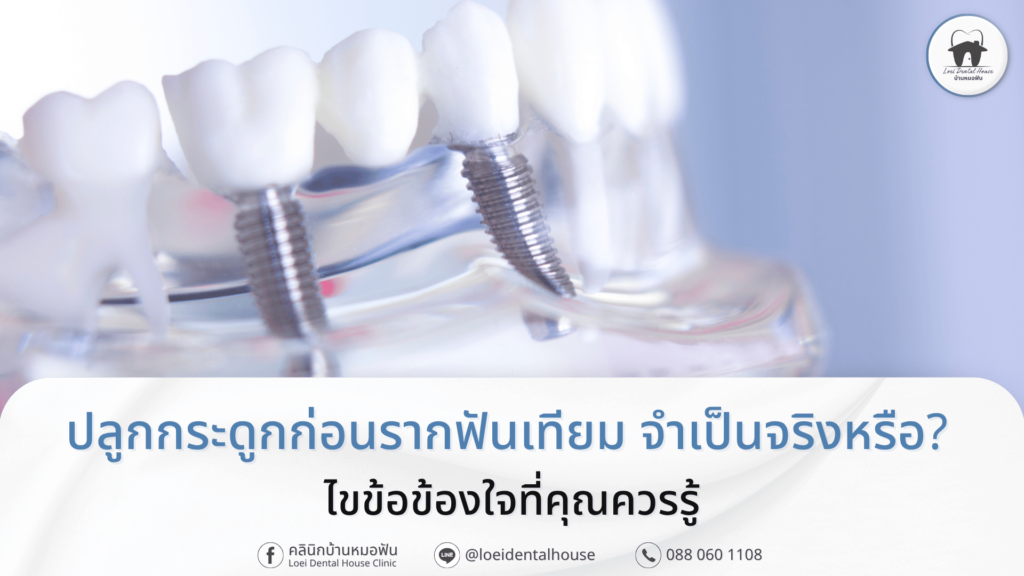 ปลูกกระดูกก่อนรากฟันเทียม จำเป็นจริงหรือ_ ไขข้อข้องใจที่คุณควรรู้