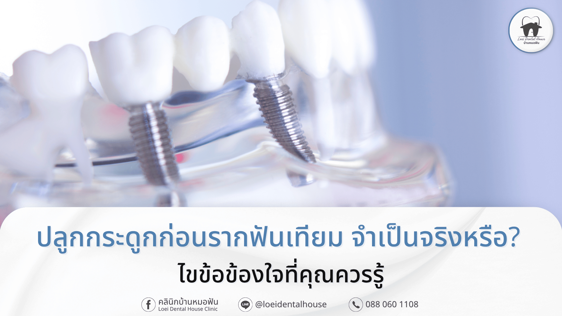 ปลูกกระดูกก่อนรากฟันเทียม จำเป็นจริงหรือ_ ไขข้อข้องใจที่คุณควรรู้
