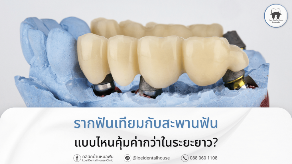 รากฟันเทียมกับสะพานฟัน แบบไหนคุ้มค่ากว่าในระยะยาว