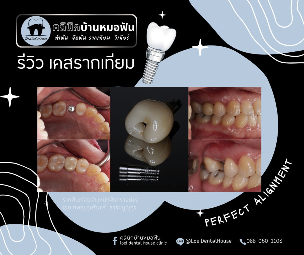 รีวิวรากฟันเทียม ราคา รีวิวรากฟันเทียม ราคา