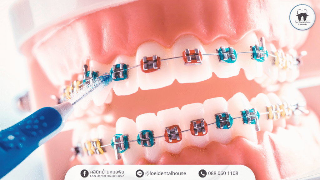 do-braces-change-face-shape-facts-and-myths-1