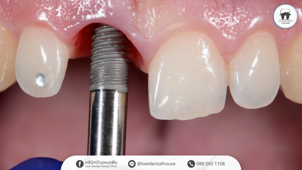dental-implant-timeline-from-start-to-finish-1