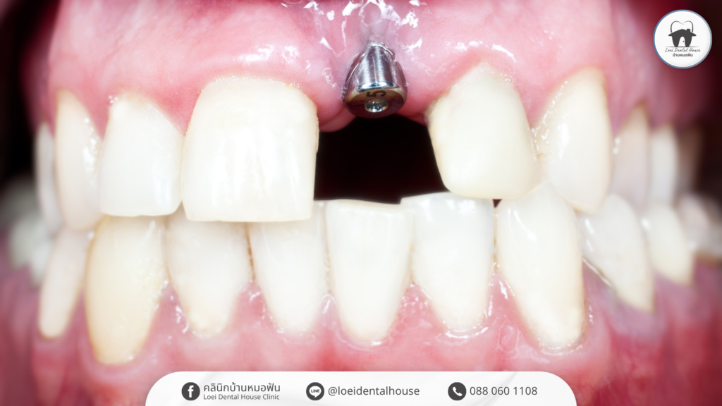 dental-implant-timeline-from-start-to-finish-3
