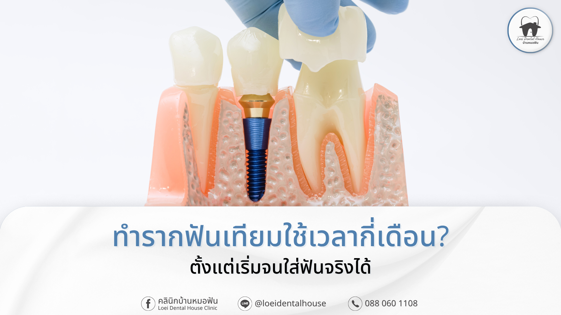 ทำรากฟันเทียมใช้เวลากี่เดือน