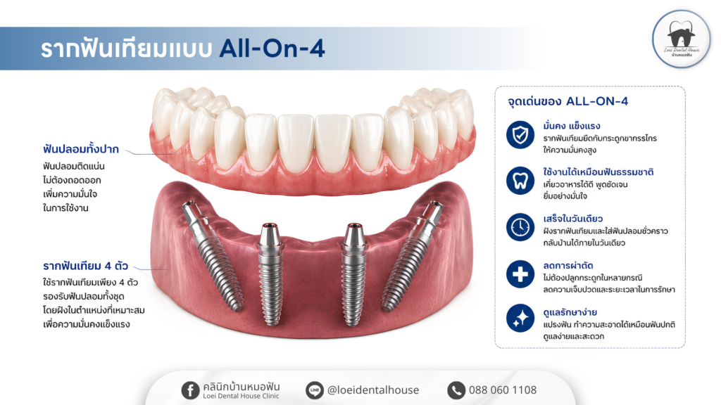 รากฟันเทียม all on 4