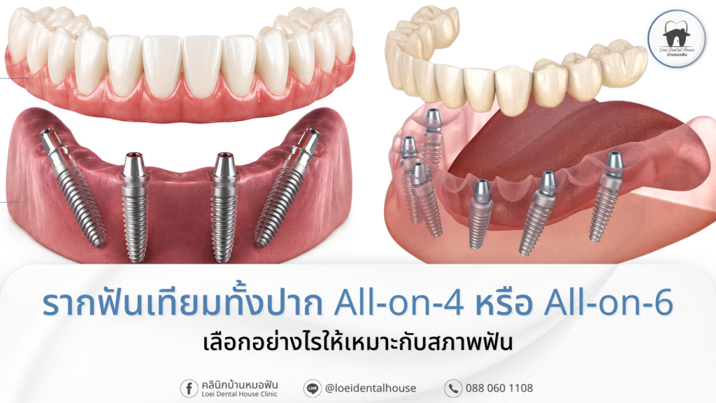 เปรียบเทียบรากฟันเทียมทั้งปากแบบ all on 4 กับ all on 6