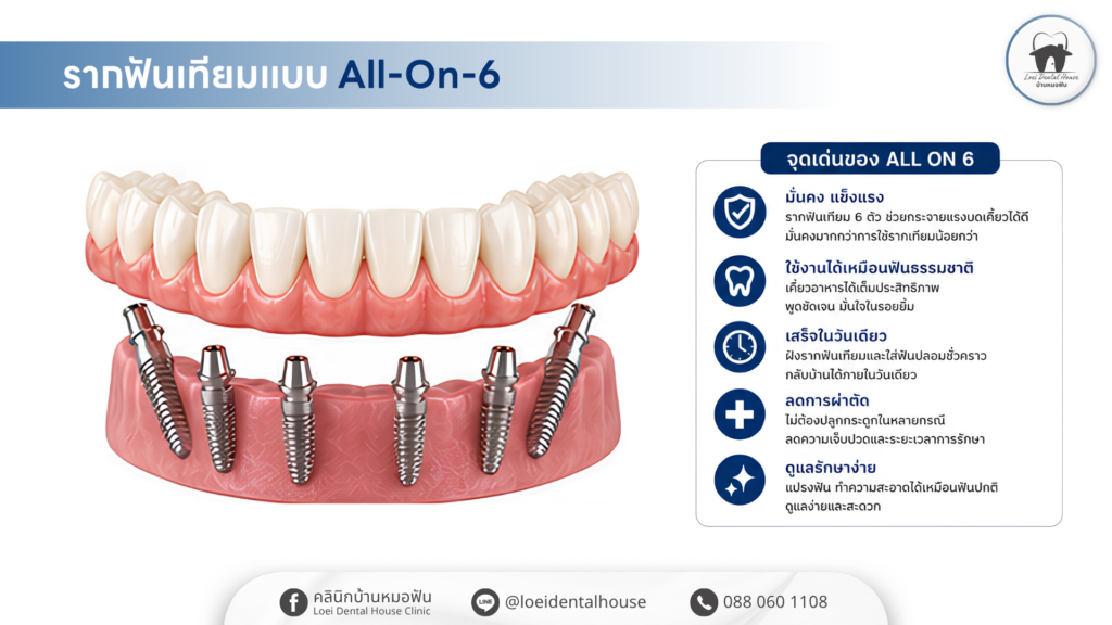 รากฟันเทียมแบบ all on 6