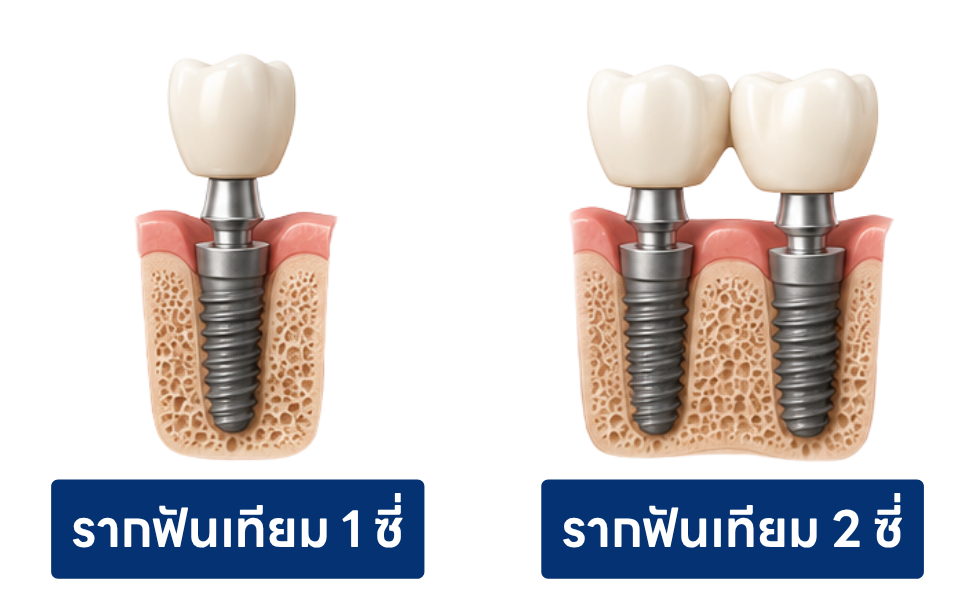 รากฟันเทียม 1-2 ซี่ รากฟันเทียม 1-2 ซี่