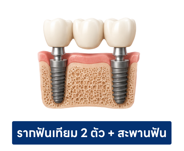 รากฟันเทียม 2 ตัว พ้อมสะพานฟัน 3 ยูนิต รากฟันเทียม 2 ตัว พ้อมสะพานฟัน 3 ยูนิต