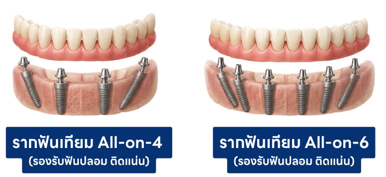 รากฟันเทียมสำหรับฟันปลอมติดแน่น รากฟันเทียมสำหรับฟันปลอมติดแน่น
