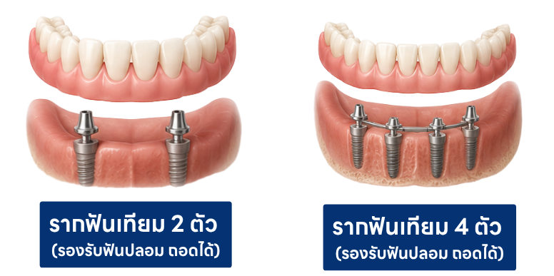 รากฟันเทียมสำหรับฟันปลอมถอดได้ รากฟันเทียมสำหรับฟันปลอมถอดได้